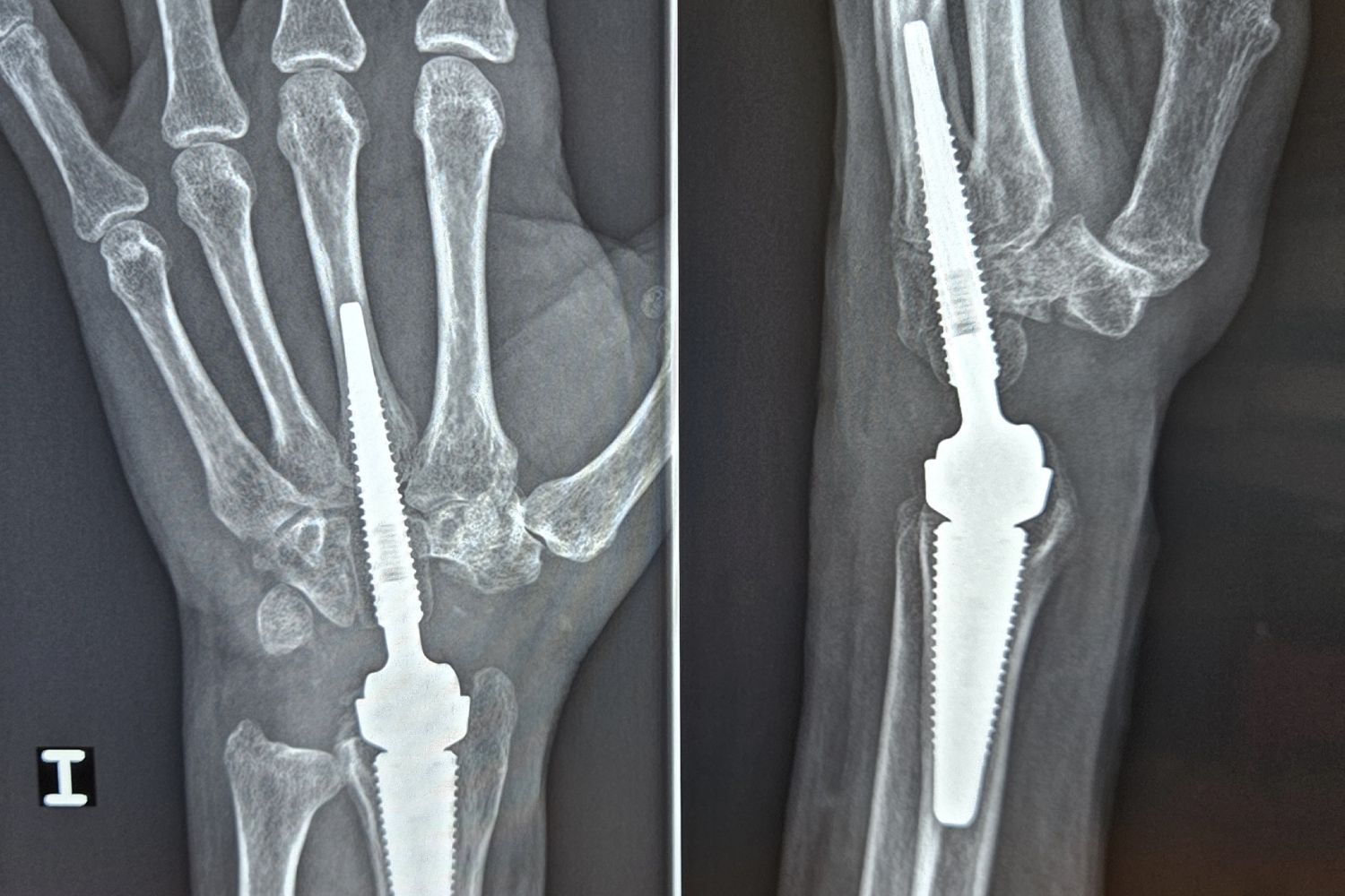 Nuevas Pr tesis Para Artroplastia De Mu eca Que Eliminan Dolor Nuevas Pr tesis Para Artroplastia De Mu eca Que Eliminan Dolor