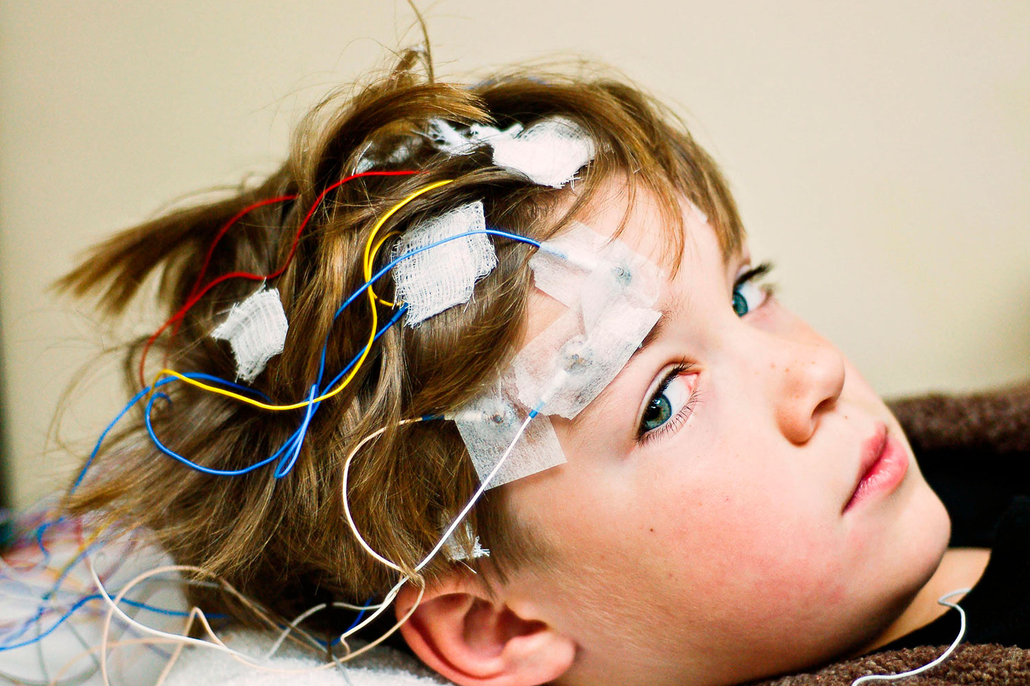 Epilepsia infantil: más allá del control de crisis hacia un tratamiento personalizado