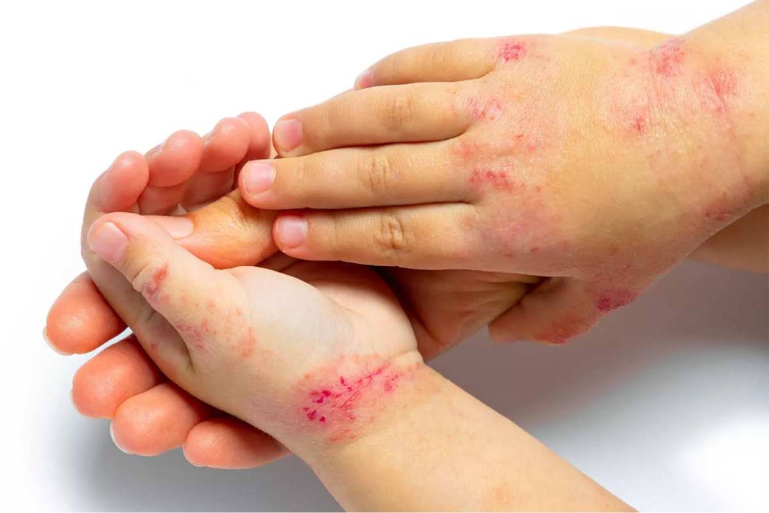 Ni menos picor ni mejor sueño: los antihistamínicos aportan poco o nada en dermatitis atópica