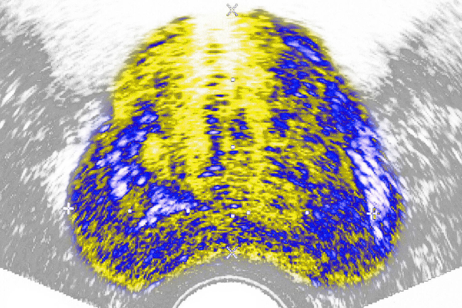 Una nueva estrategia con Lutecio-177 mejora resultados en cáncer de próstata metastásico