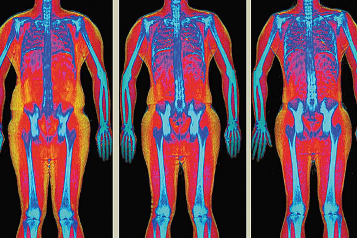 GLP-1 y pérdida de masa magra: una terapia de ARN explora la vía de la termogénesis