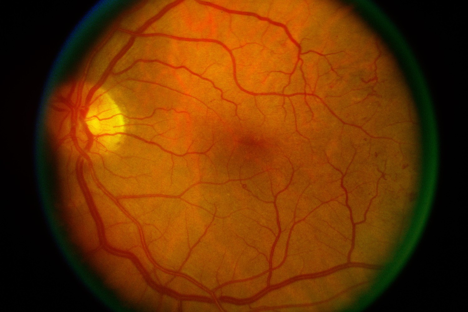 Futuro de la retinopatía diabética: terapias más allá de las inyecciones intravítreas