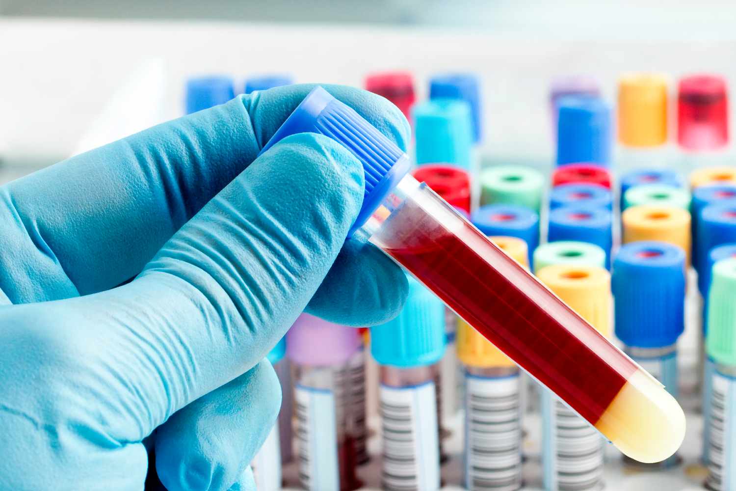 La biopsia líquida acerca las terapias dirigidas a más casos de cáncer de vías biliares