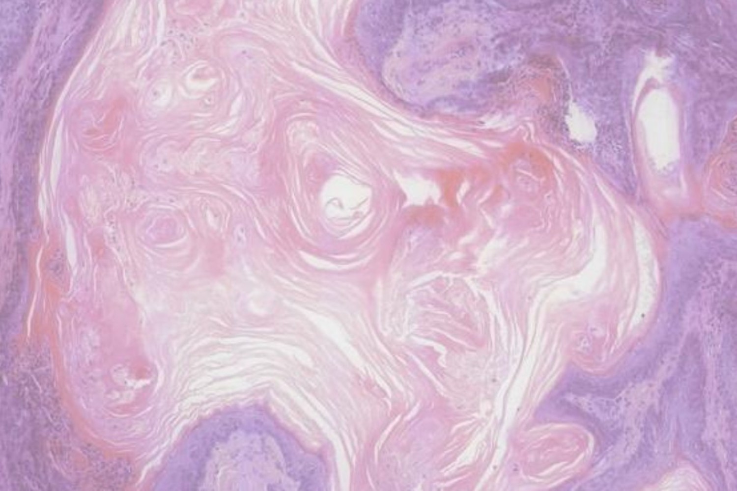 'Keytruda', recomendado en combinación con enfortumab para cáncer de vejiga