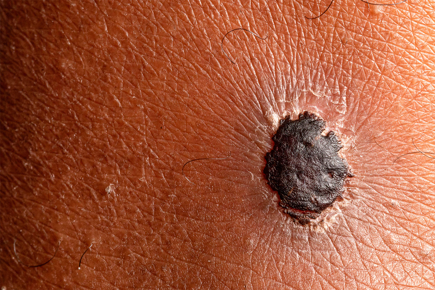 Melanoma: de tratar el tumor a adaptar la terapia a su respuesta