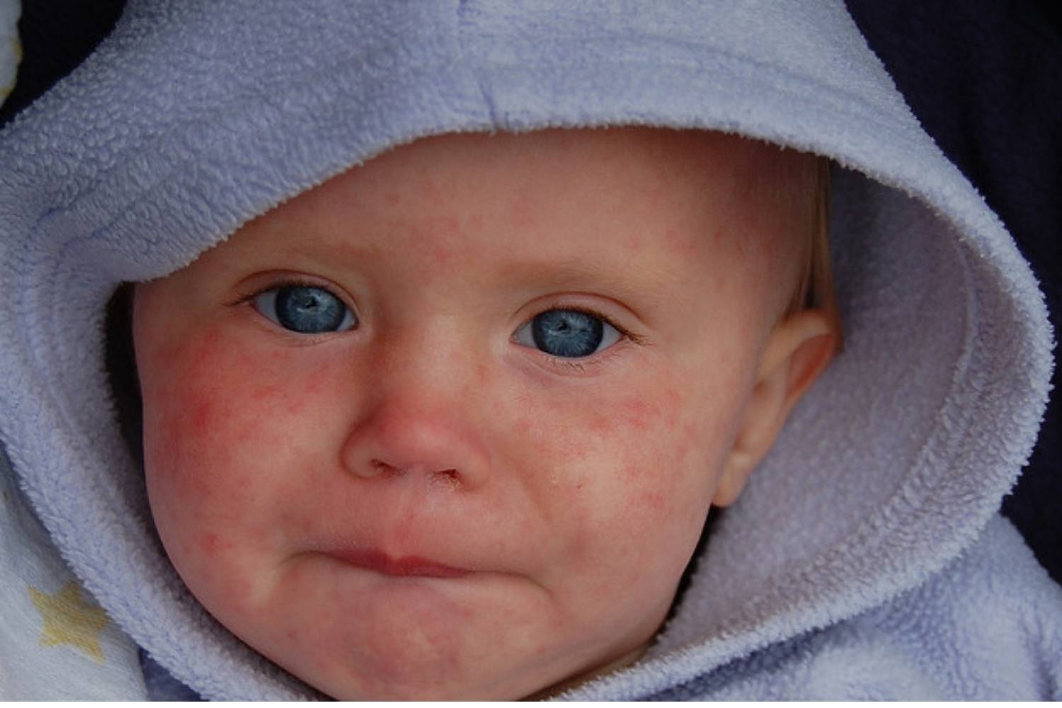 La reparición del sarampión en España pone en alerta a los pediatras