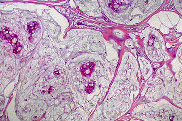 Imagen histológica de cáncer de mama. 