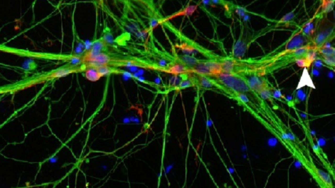 Neuronas Parkinson 