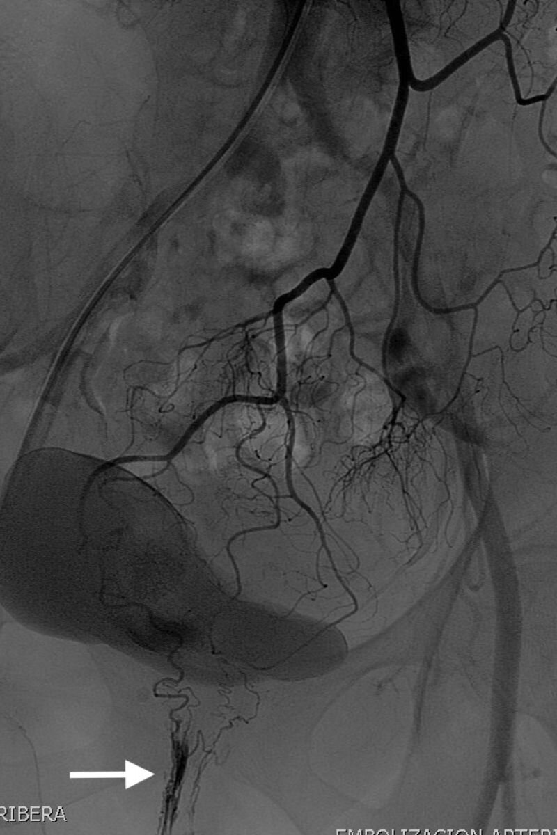 Arteriografía de la arteria mesentérica inferior donde se aprecia la arteria rectal superior como rama terminal que rodea al recto observándose el paquete hemorroidal ingurgitado (flecha). Foto: DFP.