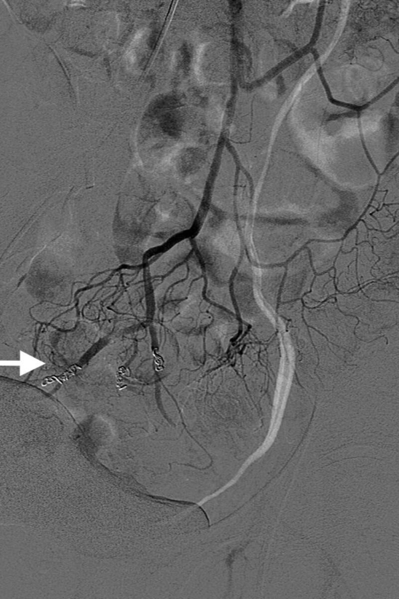 Resultado final donde se observa la embolización intraarterial con coils (flecha) de cada rama de la arteria rectal superior. El plexo hemorroidal ya no recibe vascularización y las hemorroides internas dejan de sangrar. Foto: DFP. 