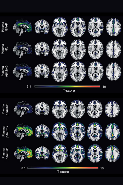 Comparación de los distintos biomarcadores de Alzheimer.