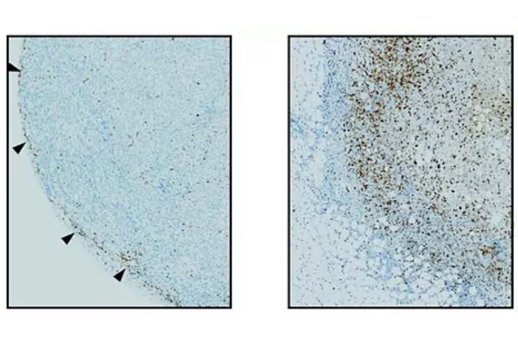 A la izquierda, las células CAR-T (puntos marrones) son excluidas de un tumor pancreático inmunodeprimido; a la derecha, las células CAR-T mejoradas con IL-2 pueden infiltrarse y matar el tumor pancreático. Foto: G. ALLEN AND W. LIM