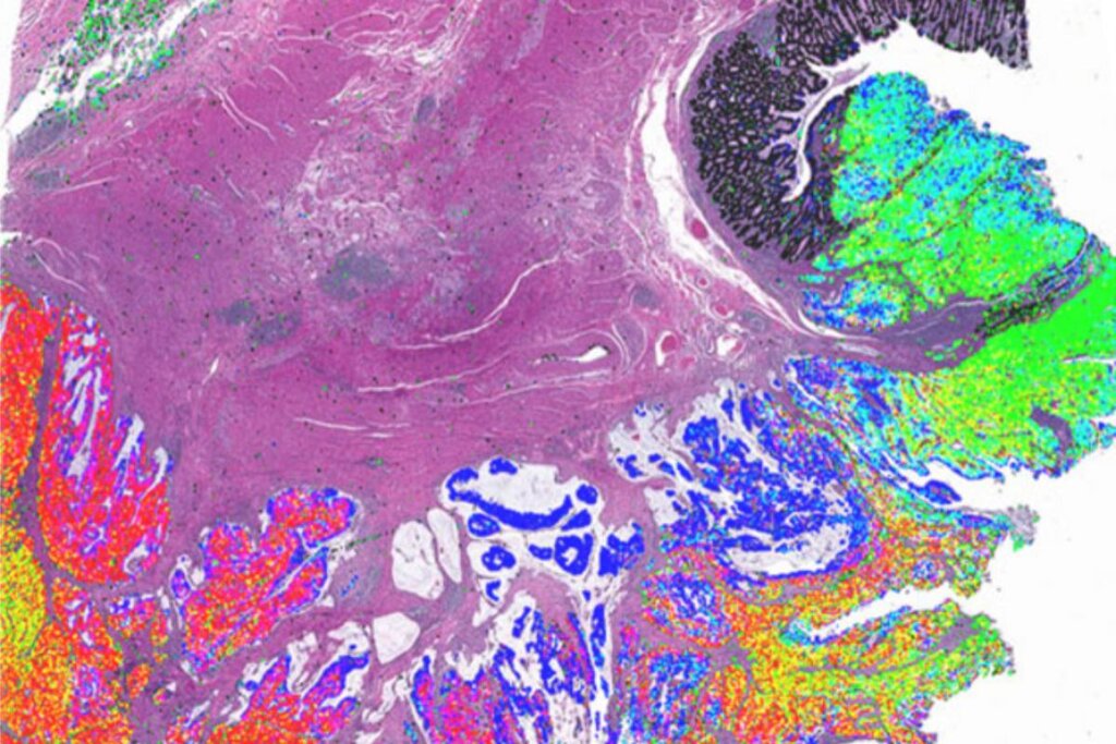 Los investigadores están combinando información histológica obtenida a través de la patolog�a tradicional (rosa y púrpura) con datos moleculares adquiridos a través de imágenes multiplexadas de última generación (verde fluorescente, amarillo, rojo y azul) para construir mapas detallados del cáncer colorrectal. Imagen: HARVARD.
