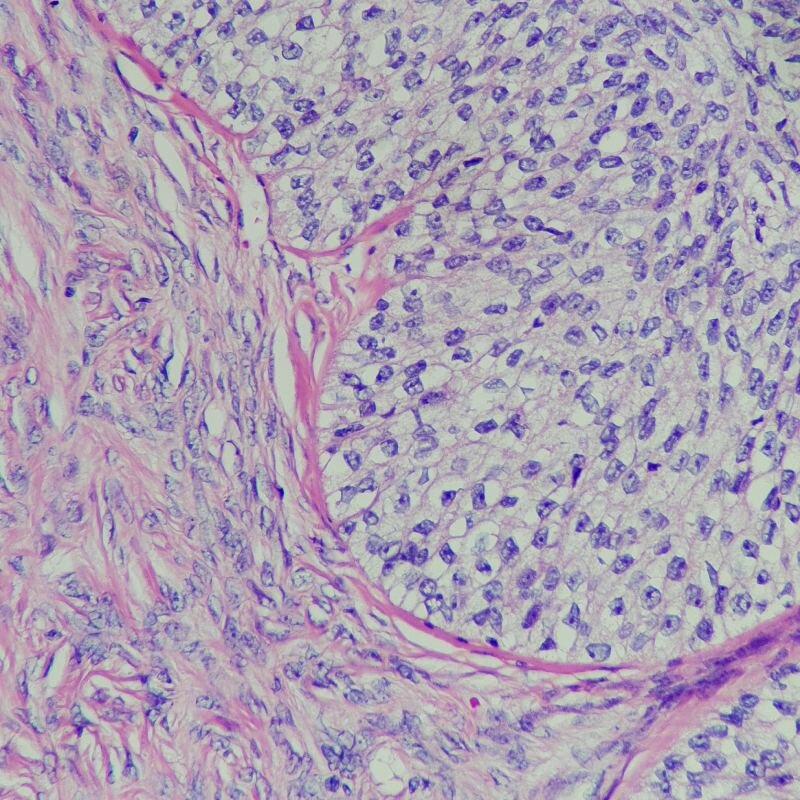 Tumor ovario y estroma (en el lado izquierdo) vistos al microscopio.