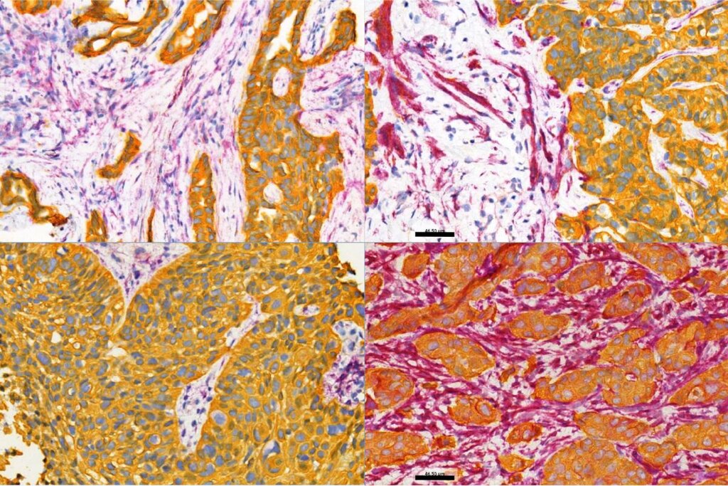 Visualización de la expresión de FAP al inicio del estudio. Se muestran imágenes representativas de cuatro muestras de pacientes de NSCLC (cáncer de pulmón de células no pequeñas) fijadas con formalina e incluidas en parafina (NSCLC metastásico) teñidas con IHC doble para FAP (púrpura) y panCK (amarillo oscuro) con diferentes patrones y expresión de FAP. Fuente: MELERO Y COLS.