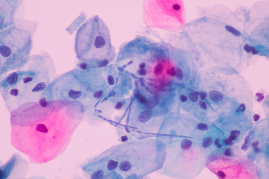 Una infección por candidiasis vista al microscopio. Foto: SHUTTERSTOCK.