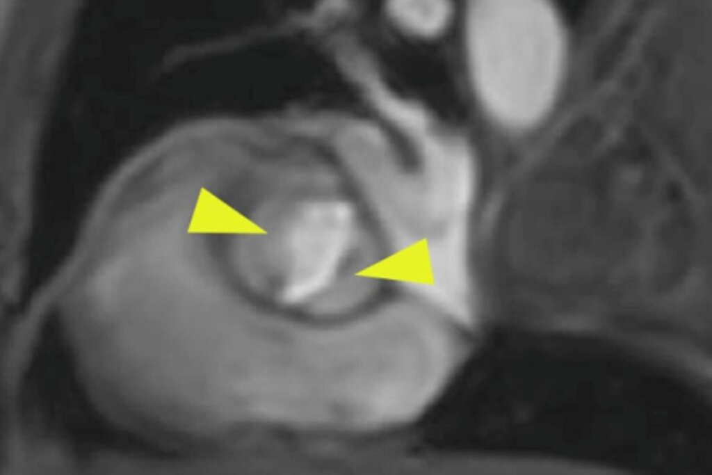Imagen de RMN en la que se ve la válvula bicúspide (puntas de flecha). Imagen: CNIC. 