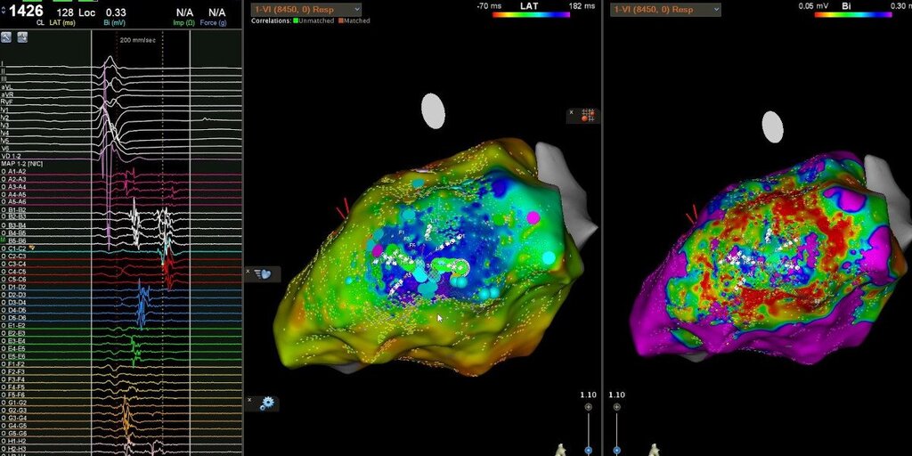 Tormenta ventricular.