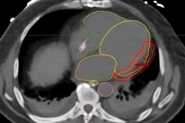 Tormenta ventricular.