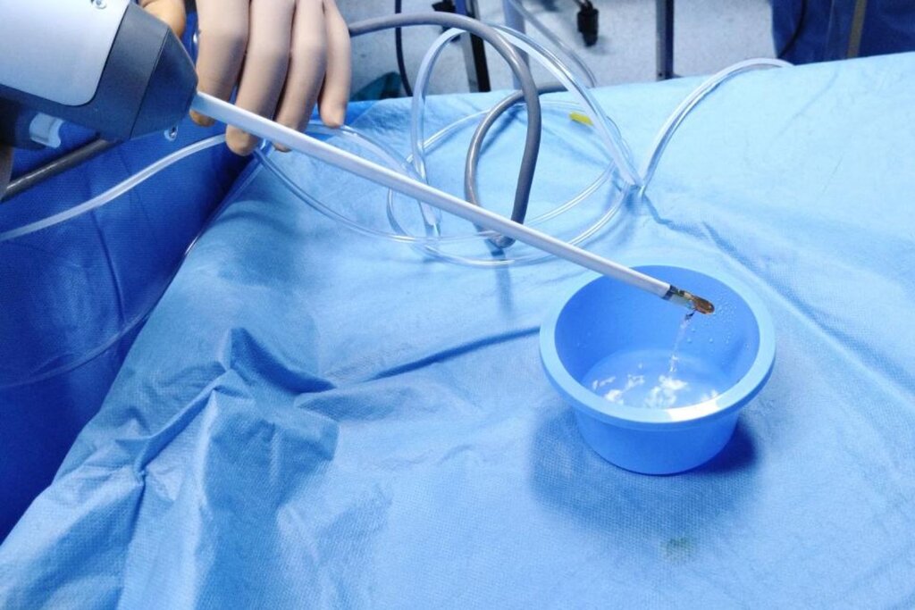 La técnica consiste en aplicar vapor de agua a 70 grados centígrados mediante varias punciones, con sedación. Foto: HOSPITAL CLÍNICO. 