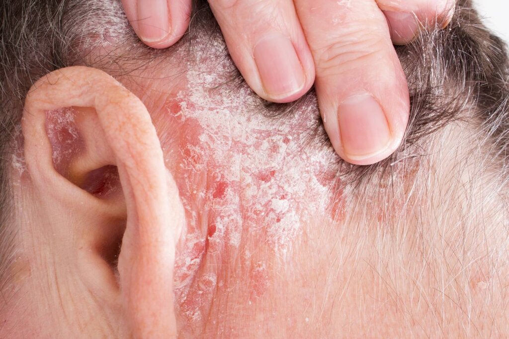 En pacientes con psoriasis y afectación en el cuero cabelludo, deucravacitinib logra en el 70% un aclaramiento total o casi total a la semana 16. Foto: SHUTTERSTOCK