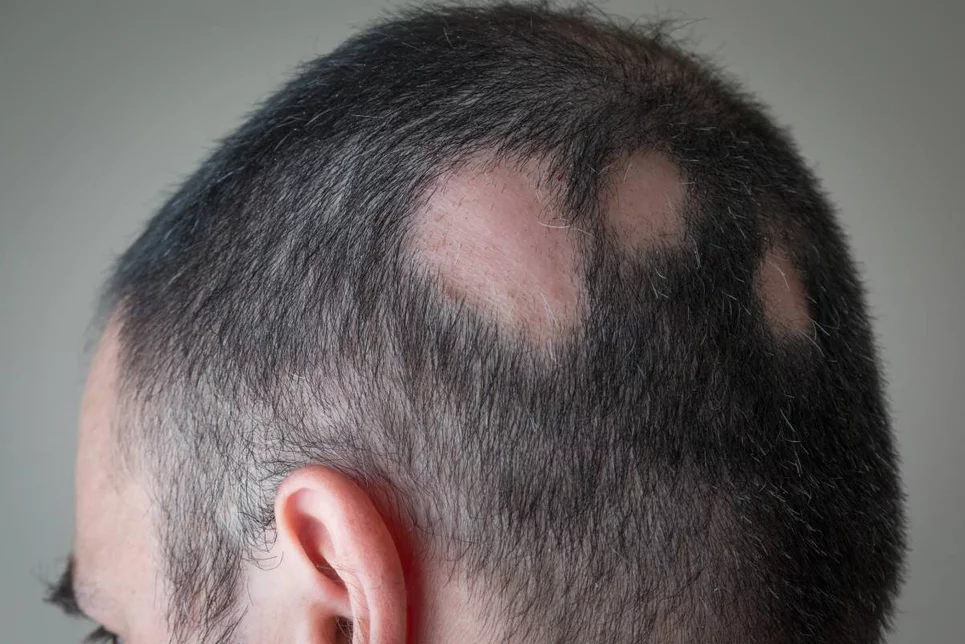 Parches redondos característicos de la alopecia areata. 