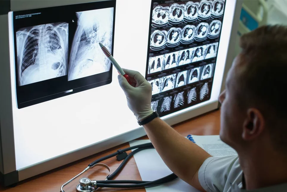 Radiografías de un paciente con EPOC. Foto: SHUTTERSTOCK