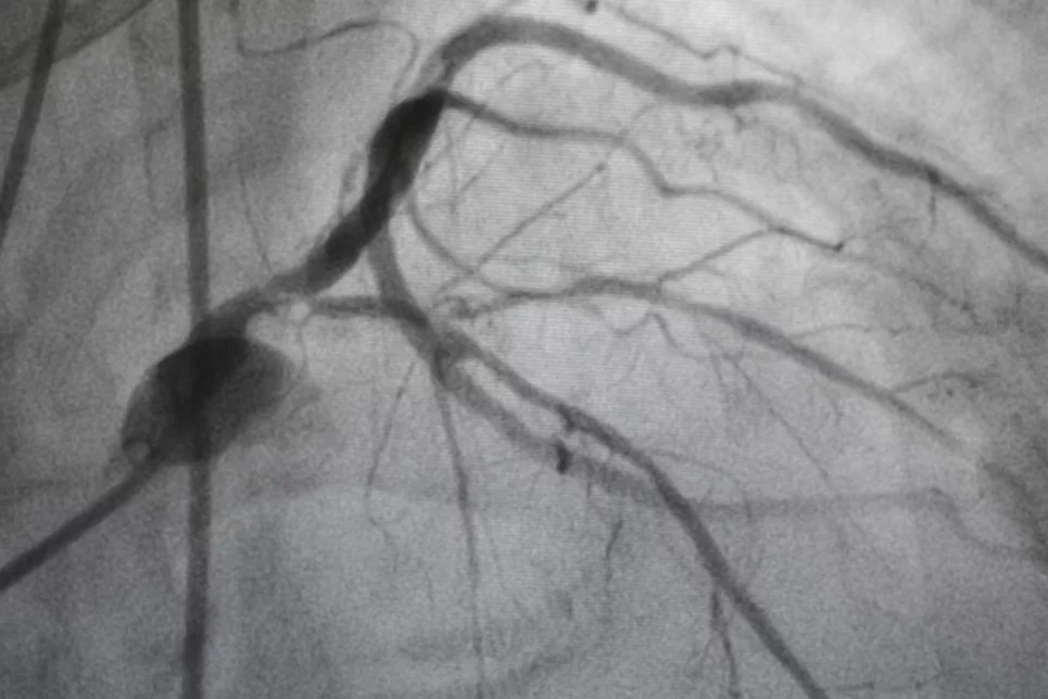 Angiografía coronaria. Foto: SHUTTERSTOCK.