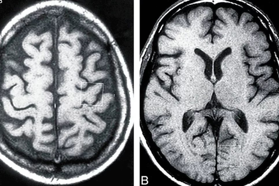 Imágenes de resonancia magnética de un paciente con esclerosis lateral amiotrófica. Foto: DM