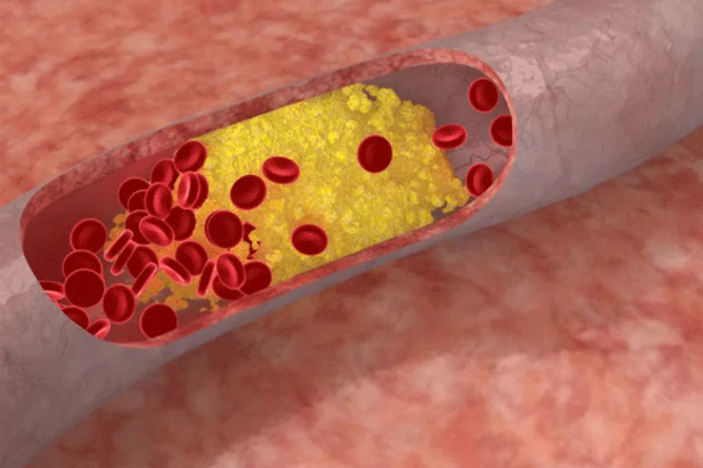 Placa de colesterol en una arteria.