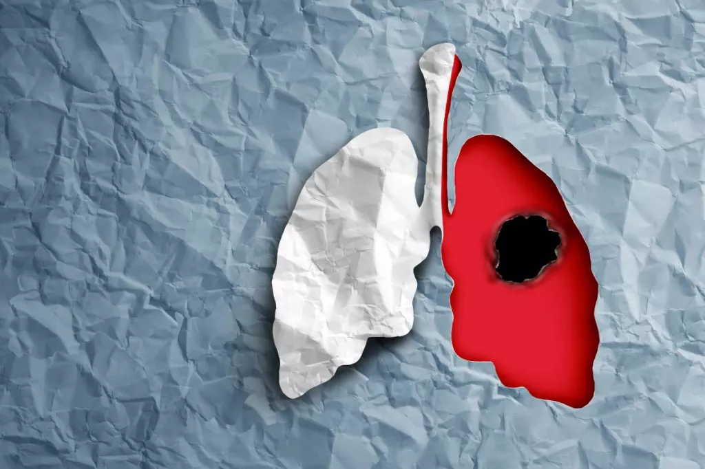 Cáncer de pulmón