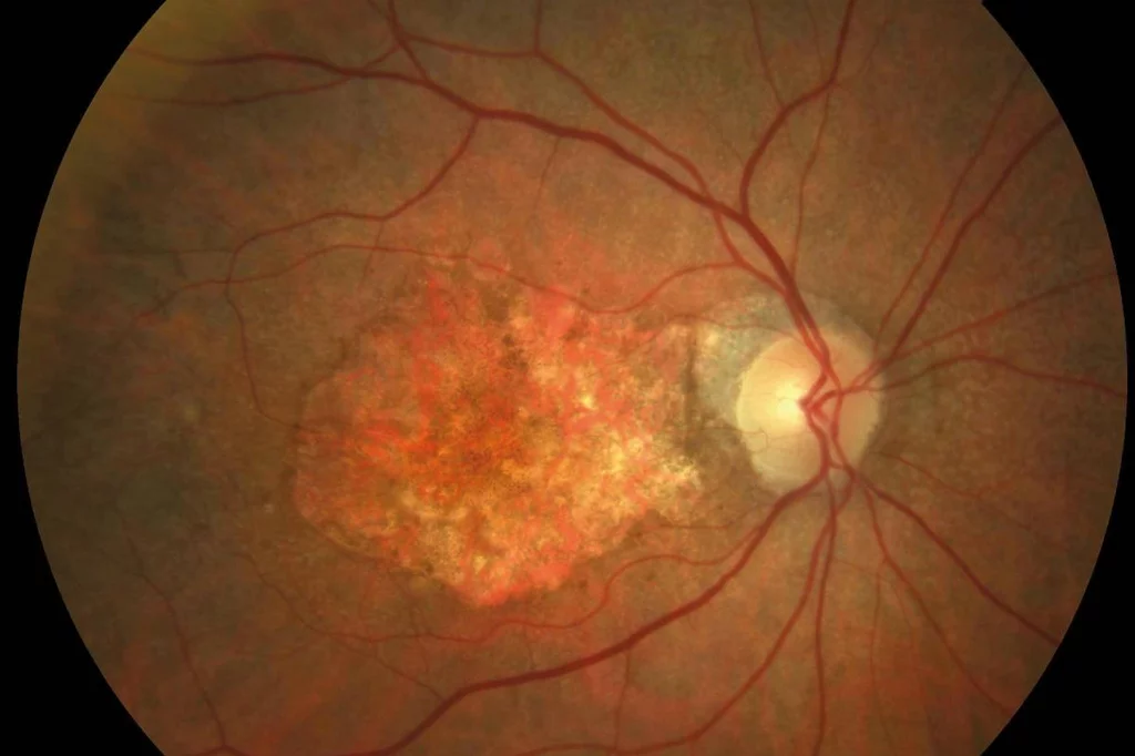 En EspaÃ±aÂ se estima que la prevalencia de la degeneraciÃ³n macular asociada a la edad (DMAE) temprana es de un 15% en las personas entre 65 y 74 aÃ±os; de un 25%, en las de 75 a 84 aÃ±os, y del 30%, en los mayores de 85 aÃ±os.