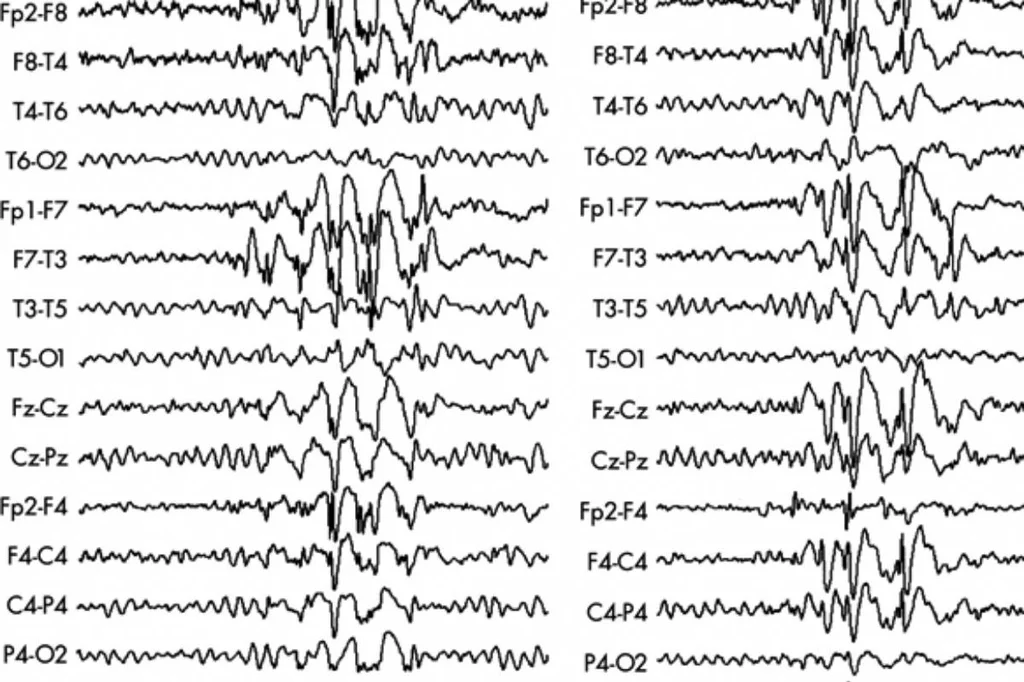 Registro encefalográfico de una crisis epiléptica. 