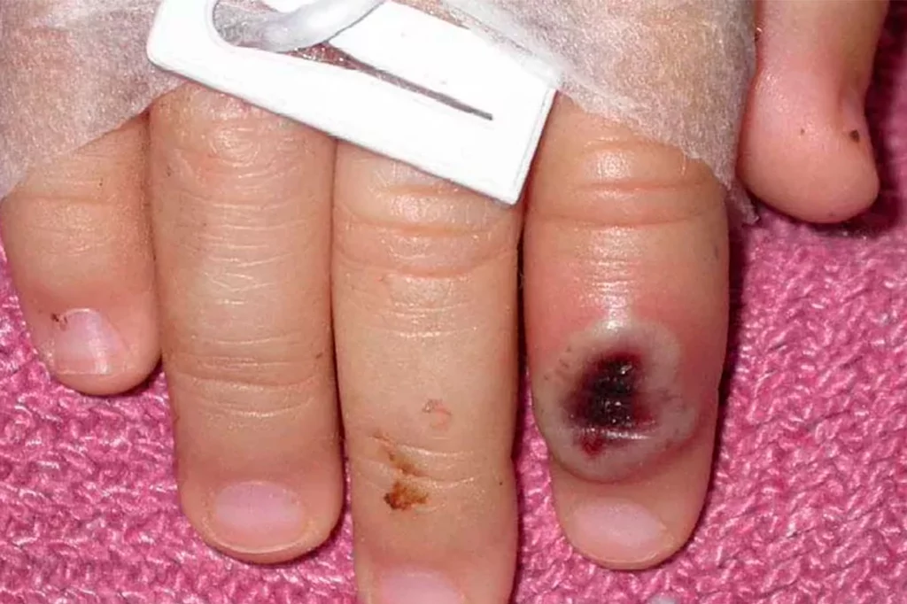 FotografÃa del Centro Estadounidense de Control de las Enfermedades (CDC) en la que se aprecia el dedo de un niÃ±o infectado por la viruela. Foto: CORTESÃA CDC/EFE