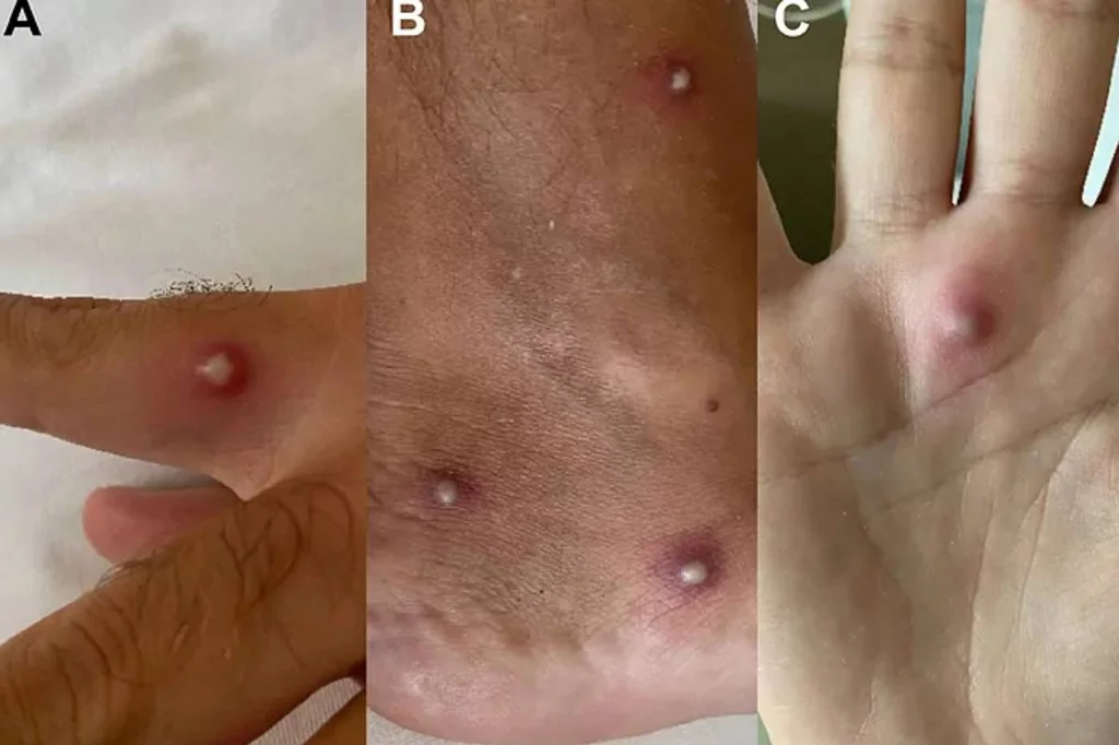 Imágenes de algunas de las lesiones cutáneas del pacientes provocadas por la viruela del mono. Foto: JOURNAL OF INFECTION.