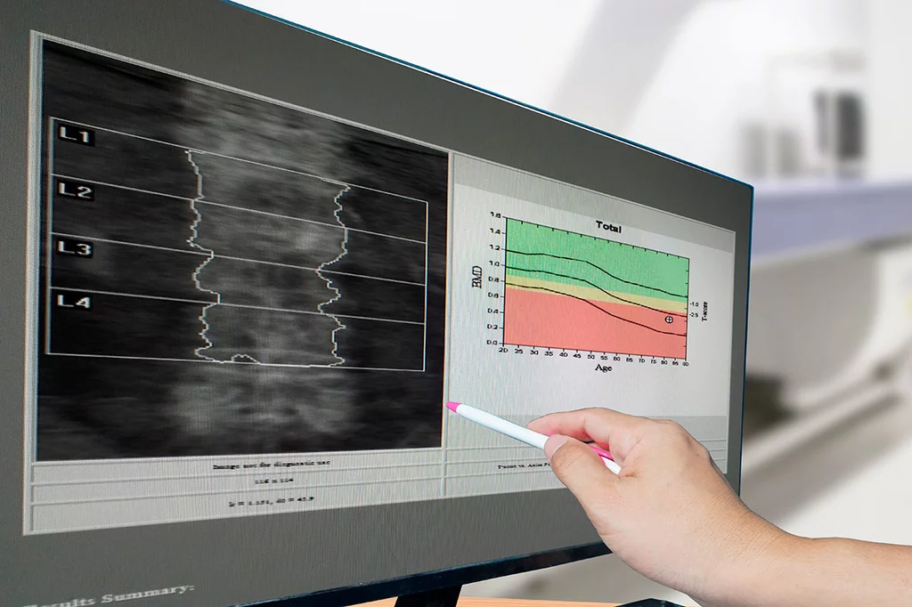 La hipertensiÃ³n arterial podrÃa favorecer la pÃ©rdida Ã³sea y la osteoporosis.