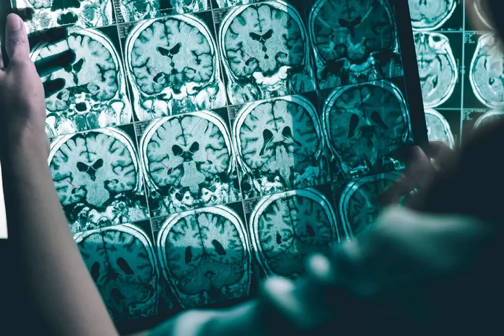 La acumulación de prote�na tau en el cerebro se relaciona con el desarrollo de Alzheimer. Foto: DM. 