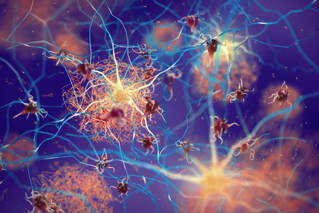 Ilustración de proteína beta-amiloide que interrumpe la función de las células nerviosas en un cerebro con enfermedad de Alzheimer.