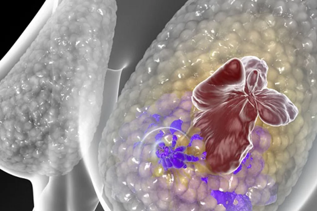 Nuevos genes parecen otorgar predisposición a cáncer familiar. Foto: DM. 