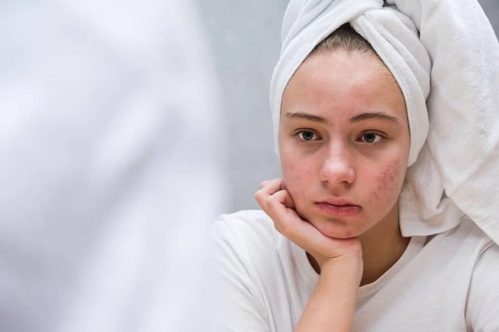 El acné es una afección de la piel que suele darse durante la pubertad. Foto: SHUTTERSTOCK