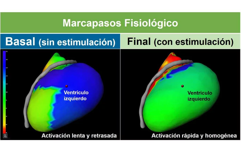 Terapia de resincronización cardíaca con marcapasos fisiológico (sin y con estimulación). Imagen: HOSPITAL CLÍNIC