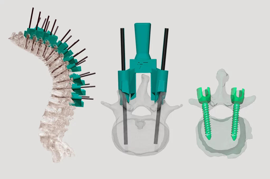 De izquierda a derecha, columna dorsal con hipercifosis en la que las guas dirigieron la colocación de 34 tornillos; la gua acoplada para la realización de dos orificios en la columna con proyección anteroposterior, e imagen de los tornillos colocados.