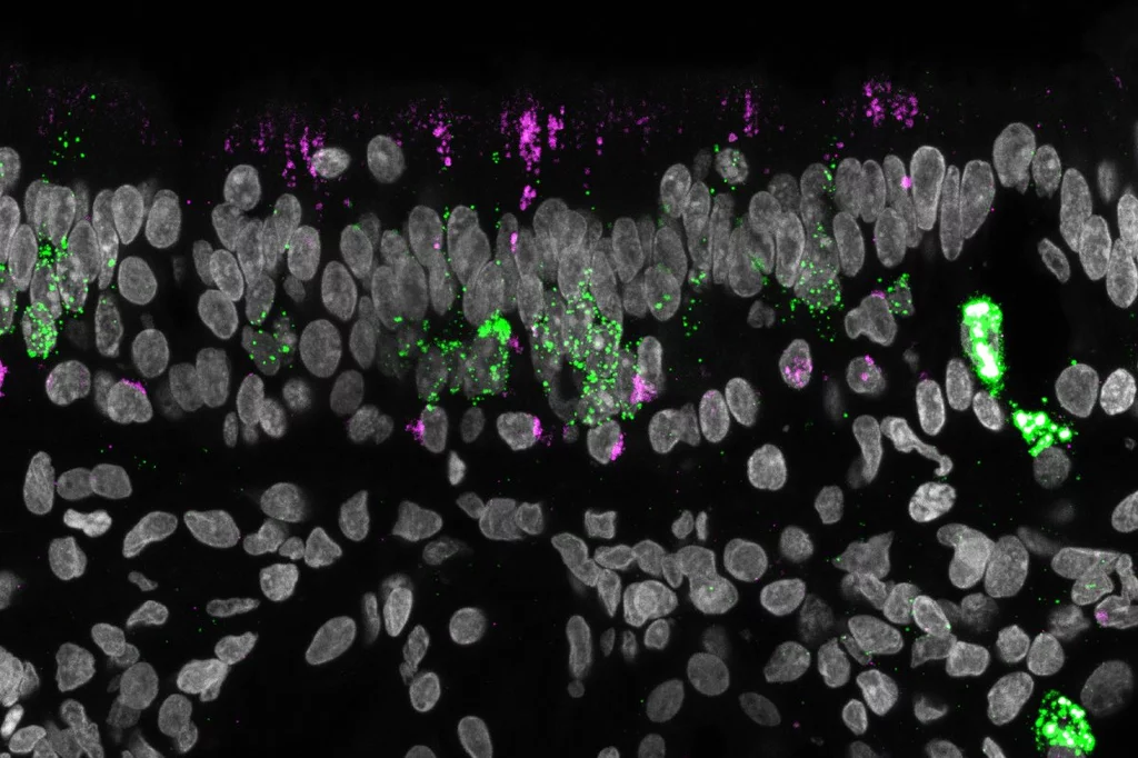 Micrografa del epitelio olfatorio humano de un paciente con covid-19, donde se marca el virus SARS-CoV-2 (magenta) y neuronas olfativas (verde). Foto: INSTITUTO ZUCKERMAN DE COLUMBIA.