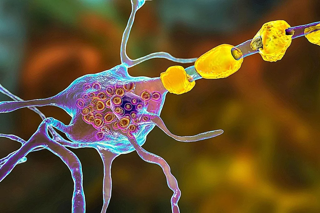 Neuronas cerebrales hinchadas con inclusiones lamelares por la acumulación de gangliósidos en lisosomas en enfermedades raras de almacenamiento lisosomal, como la de Fabry.