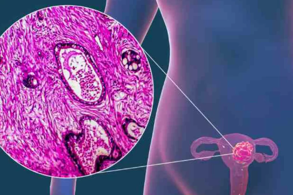 La endometriosis podra empezar a considerarse una enfermedad sistémica. Foto: DM. 