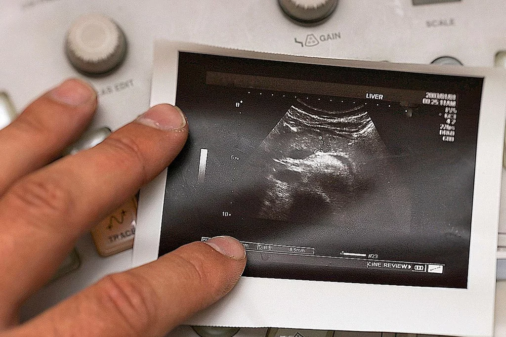 El diagnóstico tardío es uno de los problemas del cáncer de páncreas. Foto: DM. 