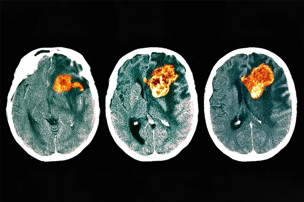 TAC a color de la cabeza de un paciente con glioblastoma. Imagen: ZEPHYR