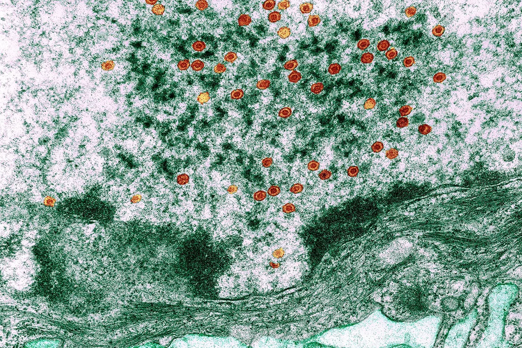 La encefalitis herpÃ©tica estÃ¡ causada por el virus del herpes simple, que en la mayorÃa de los casos solo produce infecciones banales, pero en un porcentaje de pacientes deriva en una encefalitis grave. Foto: WELLCOME COLLECTION.