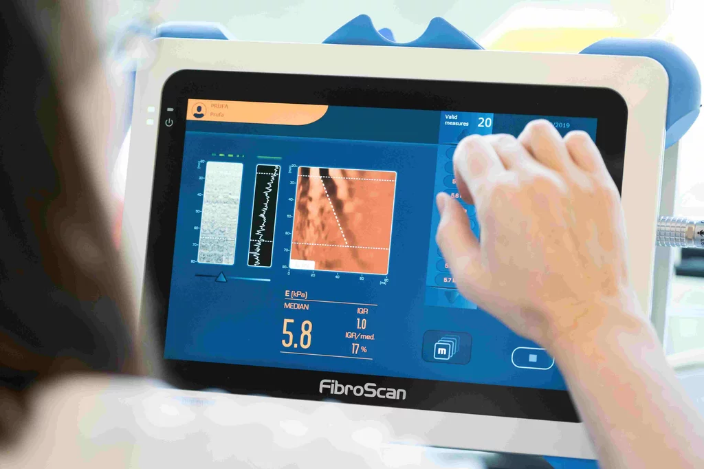 La elastografa se usa para diagnosticar hgado graso y fibrosis. Foto: DM