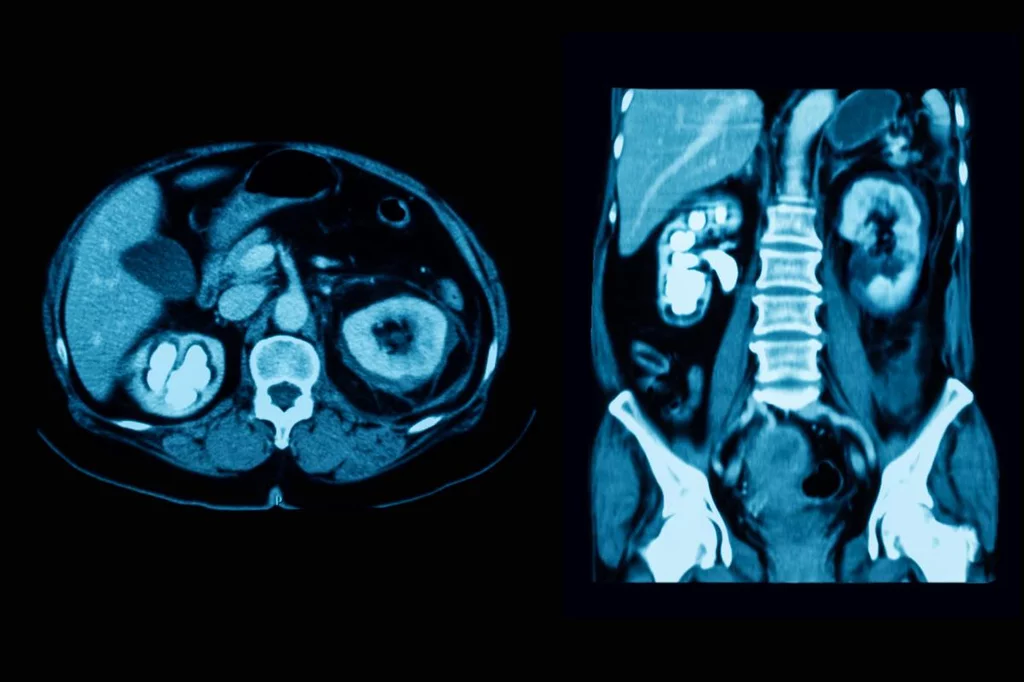 Tomografa computarizada del tracto urinario, que muestra un cálculo en el riñón derecho. Foto: SHUTTERSTOCK